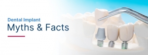 Implant Dentistry FAQs: Dispelling Myths And Misconceptions!